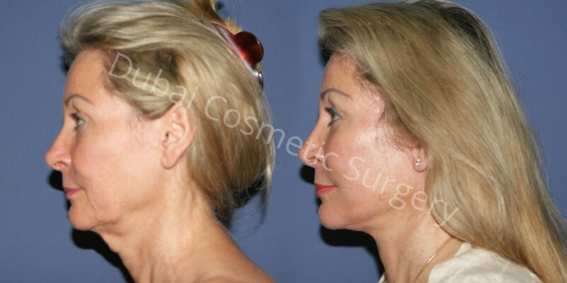 Neck-Lift-Before-and-After