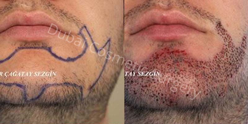 beared Hair-Transplant-Before-After-8