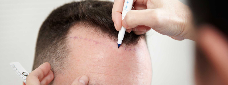 اهم 10 آثار جانبية لجراحة زراعة الشعر للرجال