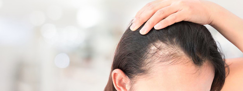مدى فعالية علاج بي ار بي في اعادة نمو الشعر
