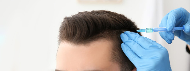 ما هو علاج الشعر PRGF؟