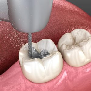 Dental Amalgam Removal